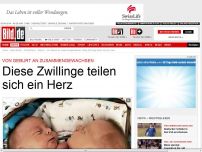 Bild zum Artikel: Von Geburt an zusammen - Diese Zwillinge teilen sich ein Herz