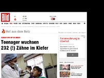 Bild zum Artikel: Sensations-OP in Indien - Teenager wuchsen 232 (!) Zähne im Kiefer