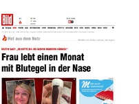 Bild zum Artikel: Frau lebt einen Monat mit Blutegel in der Nase