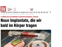 Bild zum Artikel: Verhütung, Werte messen... - 9 Implantate, die wir bald im Körper tragen