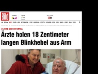 Bild zum Artikel: 51 Jahre nach dem Unfall - Ärzte holen 18 Zentimeter langen Blinker aus Arm