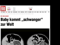 Bild zum Artikel: Mit Zwillingen! - Baby kommt „schwanger“ zur Welt