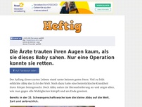 Bild zum Artikel: Die Ärzte trauten ihren Augen kaum, als sie dieses Baby sahen. Nur eine Operation konnte sie retten.