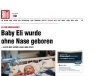 Bild zum Artikel: Seltene Erbkrankheit - Baby Eli wurde ohne Nase geboren