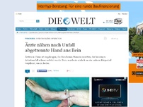Bild zum Artikel: Spektakuläre Operation: Ärzte nähen nach Unfall abgetrennte Hand ans Bein