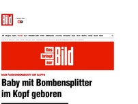 Bild zum Artikel: Nach Fassbombenangriff - Baby mit Bombensplitter im Kopf geboren