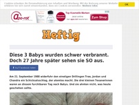 Bild zum Artikel: Diese 3 Babys wurden schwer verbrannt. Doch 27 Jahre später sehen sie SO aus.