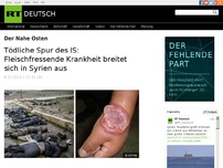 Bild zum Artikel: Tödliche Spur des IS: Fleischfressende Krankheit breitet sich in Syrien aus