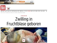 Bild zum Artikel: Chance 1:80 000 - Zwilling in Fruchtblase geboren