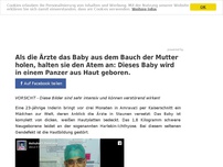 Bild zum Artikel: Als die Ärzte das Baby aus dem Bauch der Mutter holen, halten sie den Atem an: Dieses Baby wird in einem Panzer aus Haut geboren.