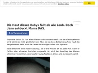 Bild zum Artikel: Die Haut dieses Babys fällt ab wie Laub. Doch dann entdeckt Mama DAS.