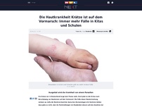 Bild zum Artikel: Die Hautkrankheit Krätze ist auf dem Vormarsch: Immer mehr Fälle in Kitas und Schulen