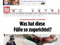 Bild zum Artikel: Angriff aus dem Meer - Was hat diese Füße so zugerichtet?