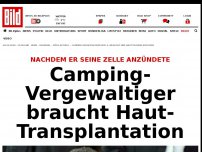 Bild zum Artikel: Schwere Verbrennungen! - Camping-Vergewaltiger braucht Hauttransplantation