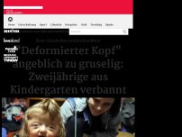 Bild zum Artikel: 'Deformierter Kopf' angeblich zu gruselig: Zweijährige aus Kindergarten verbannt