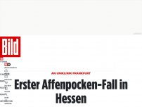 Bild zum Artikel: An Uniklinik bestätigt - Erster Affenpocken-Fall in Hessen