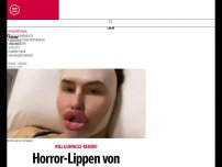 Bild zum Artikel: Horror-Lippen von Influencerin schocken das Netz