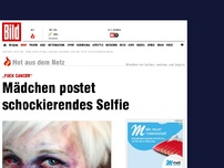 Bild zum Artikel: „Fuck Cancer“ - Mädchen postet schockierendes Selfie