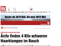 Bild zum Artikel: Ekel-Fund! - 4 Kilo schwerer Haarklumpen im Bauch