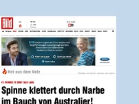 Bild zum Artikel: Es kribbelte 3 Tage - Spinne klettert durch Narbe in seinen Bauch!