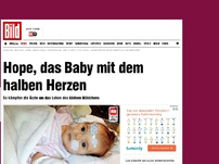 Bild zum Artikel: Ärzte kämpfen um ihr Leben - Hope, das Baby mit dem halben Herzen