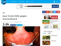 Bild zum Artikel: Aua! Erste Hilfe gegen Sonnenbrand