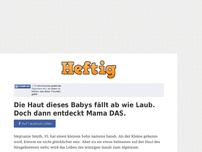 Bild zum Artikel: Die Haut dieses Babys fällt ab wie Laub. Doch dann entdeckt Mama DAS.