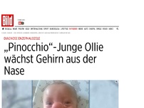 Bild zum Artikel: Ollie hat Enzephalozele - Bleib tapfer, „Pinocchio“-Junge!