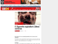 Bild zum Artikel: E-Zigarette explodiert: Zähne verloren
