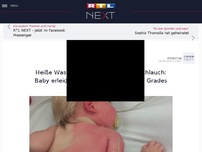 Bild zum Artikel: Gartenschlauch heizte sich in der Sonne auf: Baby erleidet Verbrennungen zweiten Grades