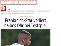Bild zum Artikel: Albtraum-Debüt für Menez - Frankreich-Star verliert halbes Ohr bei Testspiel