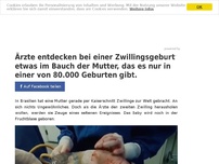 Bild zum Artikel: Die Ärzte greifen in den Bauch der Mutter, um den 2. Zwilling zu holen. Was sie dann sehen, kommt nur in einer von 80.000 Geburten vor.