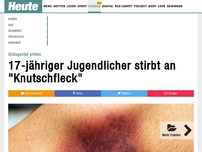 Bild zum Artikel: Schlaganfall erlitten: 17-jähriger Jugendlicher stirbt an 'Knutschfleck'