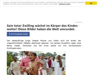 Bild zum Artikel: Sein toter Zwilling wächst im Körper des Kindes weiter! Diese Bilder haben die Welt umrundet.