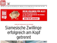 Bild zum Artikel: Gefährlicher Eingriff - Siamesische Zwillinge erfolgreich getrennt