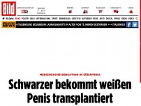 Bild zum Artikel: Medizinische Sensation - Schwarzer bekommt weißen Penis transplantiert
