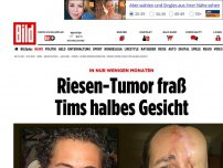 Bild zum Artikel: In nur wenigen Monaten - Riesen-Tumor fraß Tims halbes Gesicht