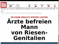 Bild zum Artikel: Nun kann er wieder laufen - Ärzte befreien Mann von Riesen-Genitalien