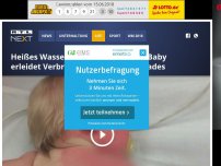 Bild zum Artikel: Heißes Wasser im Gartenschlauch: Baby erleidet Verbrennungen zweiten Grades