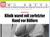 Bild zum Artikel: Krasses Foto - Klinik warnt mit zerfetzter Hand vor Böllern