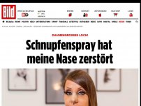 Bild zum Artikel: Daumengroßes Loch! - Schnupfenspray hat meine Nase zerstört