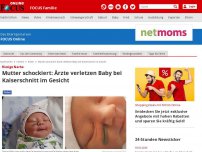 Bild zum Artikel: Riesige Narbe - Mutter schockiert: Ärzte verletzen Baby bei Kaiserschnitt im Gesicht