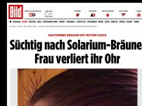 Bild zum Artikel: Hautkrebs - Solarium-Sucht! Frau verliert ihr Ohr