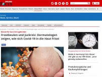 Bild zum Artikel: Muster für Sars-CoV-2 gefunden - Frostbeulen und Juckreiz: Dermatologen zeigen, wie sich Covid-19 in die Haut frisst