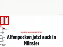 Bild zum Artikel: Sechster NRW-Fall - Affenpocken jetzt auch in Münster