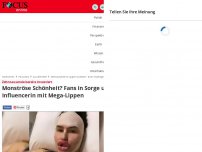 Bild zum Artikel: Zehntausende bereits investiert - Monströse Schönheit? Fans in Sorge um Influencerin mit Mega-Lippen